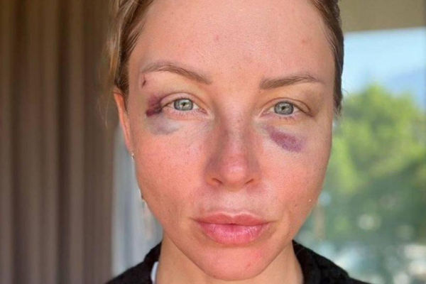 Диброва показала изувеченное лицо — развод оказался с последствиями