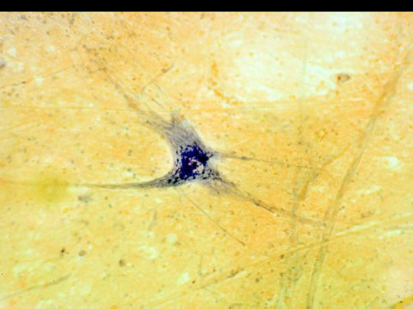 Клетки мозга людей с шизофренией оказались меньше, чем у обычных людей